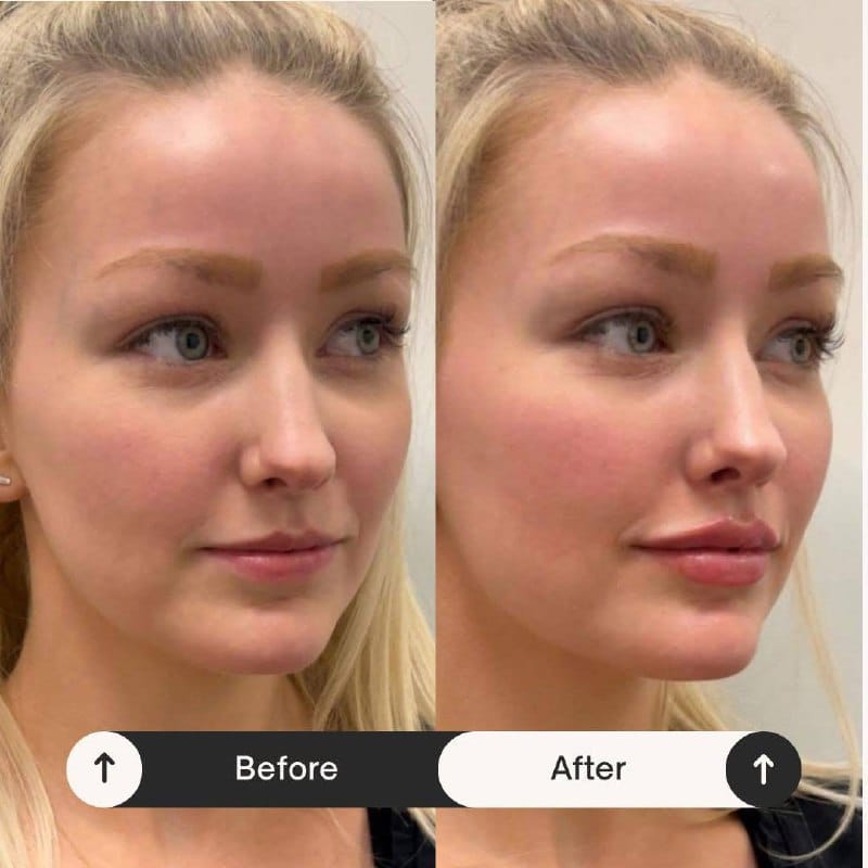 Botox / Filler — Face