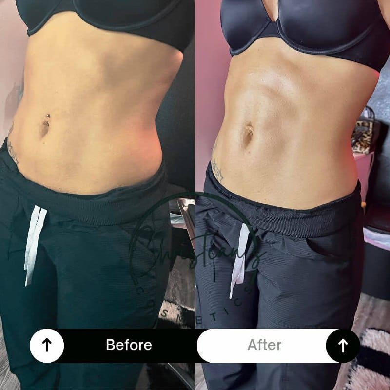 Body Sculpting — Waist