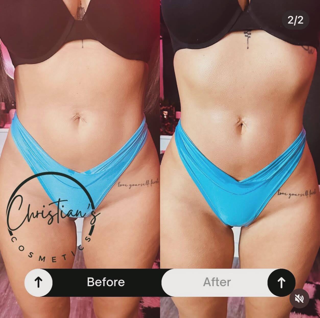 Body Sculpting — Stomach